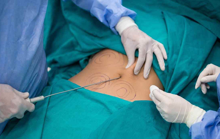 Pandemi Sürecinde Yağ Aldırma Ameliyatında En Çok Hangi Bölgeler Tercih Edildi? 7