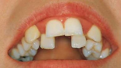 Çapraşık Dişlere Dikkat ! 1