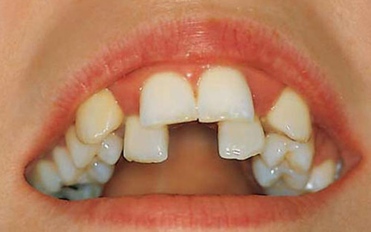 Çapraşık Dişlere Dikkat ! 1