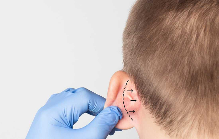 Kepçe Kulak Ameliyatı Ne Zaman Ve Kaç Yaşında Yapılır? 7