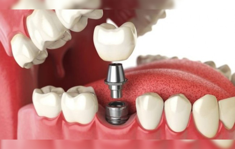 Diş İmplantı Sonrası Nelere Dikkat Edilmeli ? 7