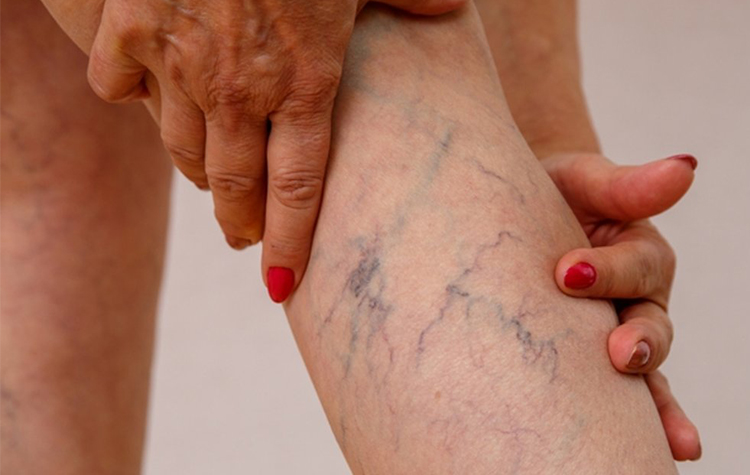 Varis Belirtilerine Dikkat ! 7