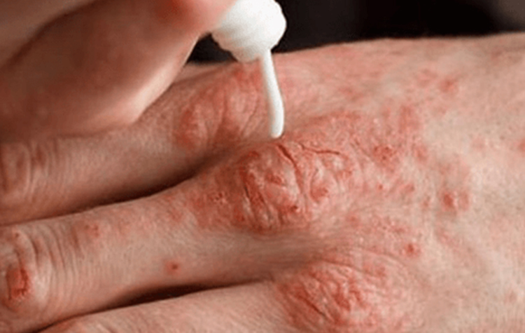 Soğuk havalarda soğuk alerjisine dikkat? 7