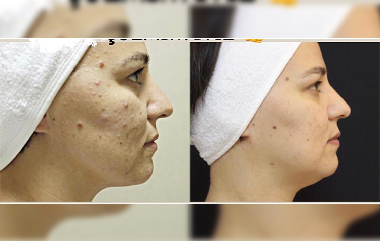 Havalar soğuyunca cilt sorunları arttı 7