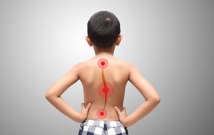 Skolyoz Tedavi Edilmezse Ne Olur? 6