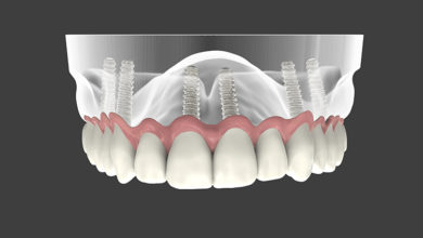 İmplant Tedavisi Sonrası Uzak Durmanız Gereken Yiyecekler 4