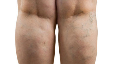 Varis Hastalarına Hayata Kolaylaştıracak Öneriler ! 3