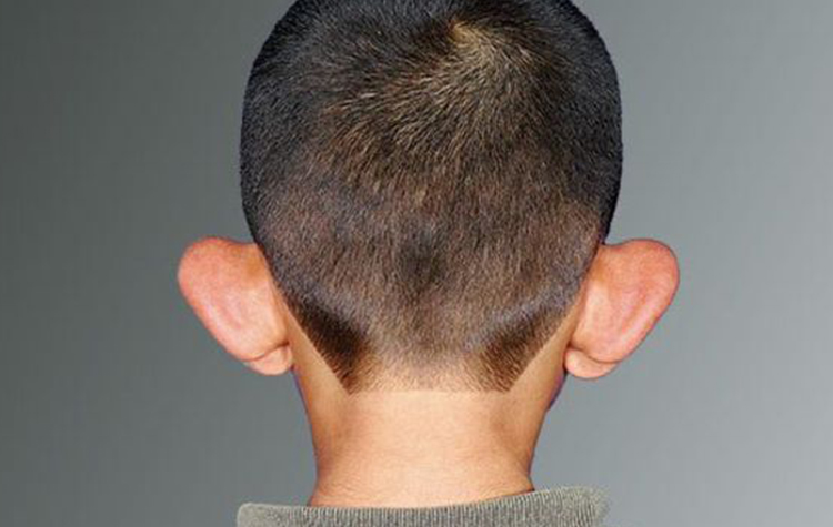 Kepçe Kulak Okul çağındaki çocukların Psikolojisini etkiliyor ! 6