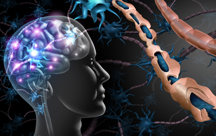 MS hakkında doğru bilinen 10 yanlış 7