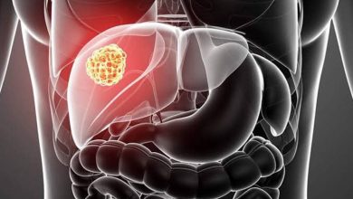 Karaciğer kistine dikkat ! 7