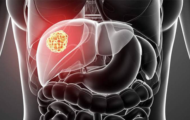 Karaciğer kistine dikkat ! 7