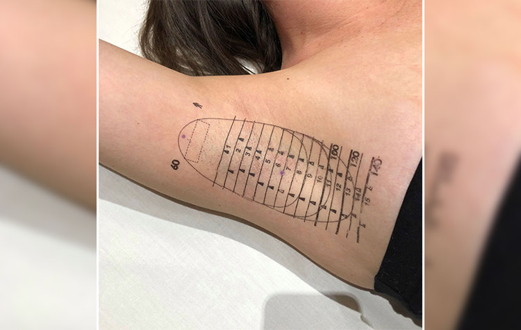 Yaz Aylarında Aşırı Terleme ve Botoks tedavisi 7