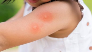 Sivrisinek ısırığı Alerjisi ve Korunma önlemleri 13