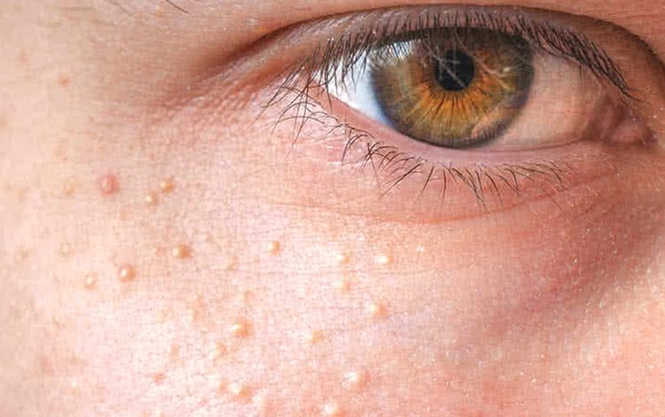 Göz çevresindeki yağ bezelerine dikkat ! 1