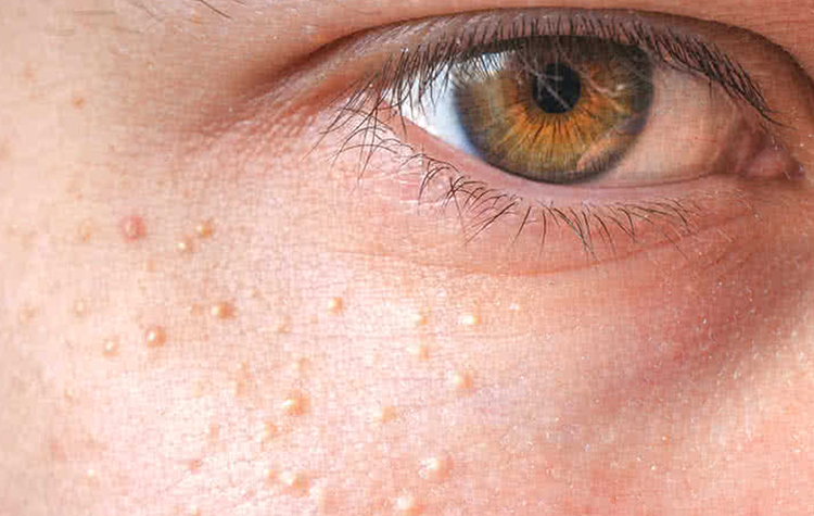 Göz çevresindeki yağ bezelerine dikkat ! 7