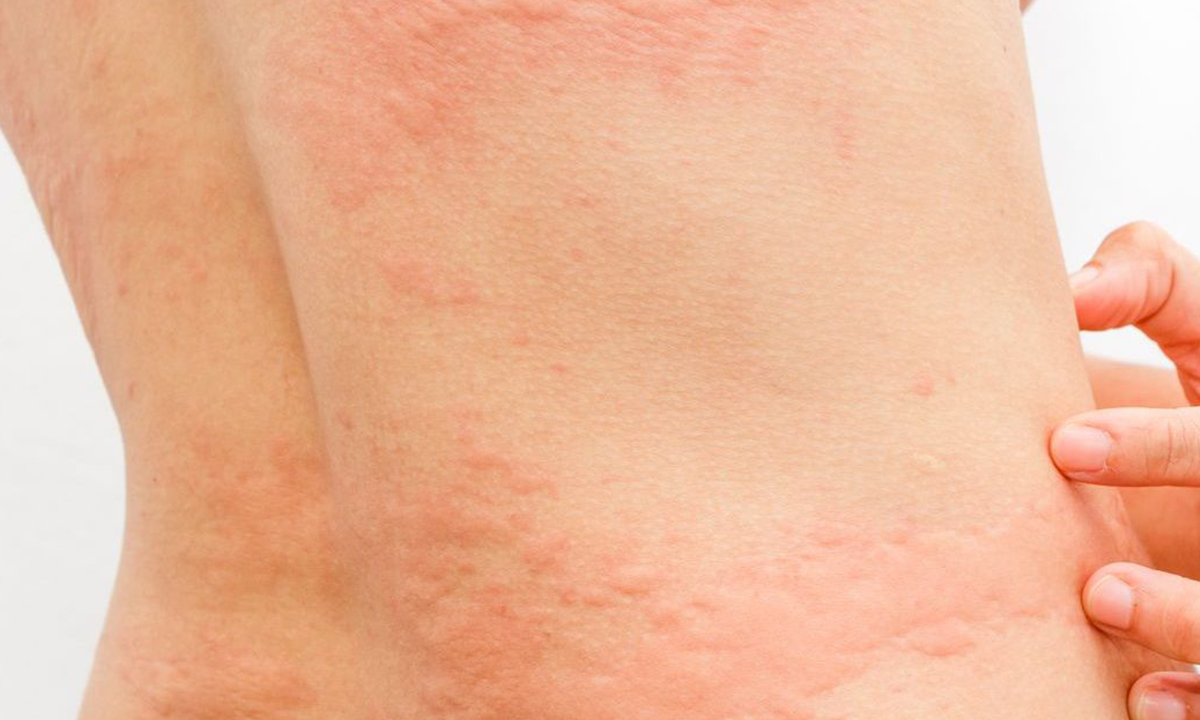 Sıcaklar, Kurdeşene Neden olabilir 7