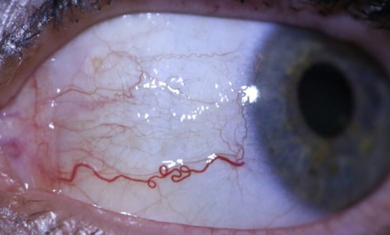 Şiddetli göz ağrısı kör olmanıza neden olabilir 1