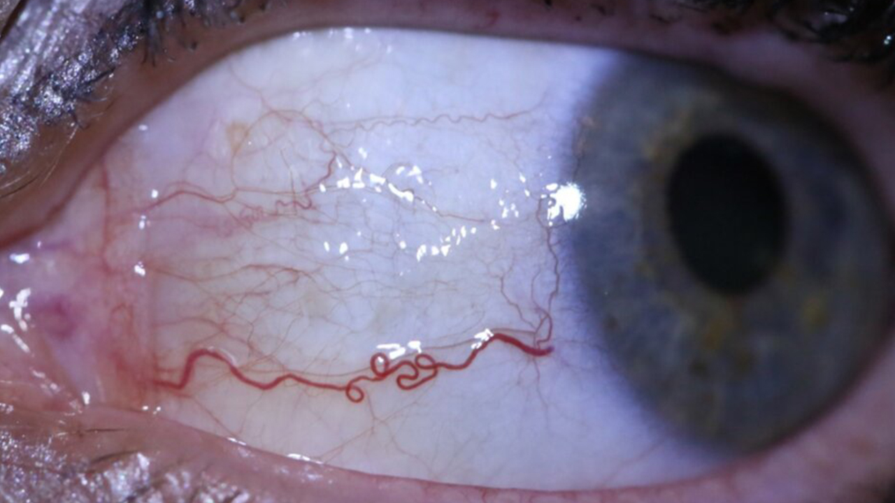 Şiddetli göz ağrısı kör olmanıza neden olabilir 7