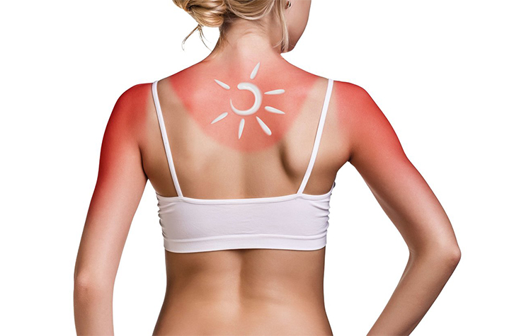 Yaz aylarının zararlı mirası; Güneş lekeleri 7