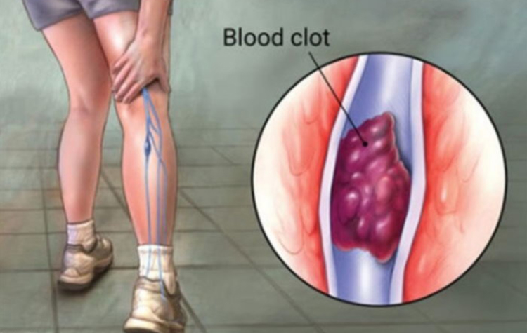 Yürürken bacağınızda ağrı mı hissediyorsunuz? 6