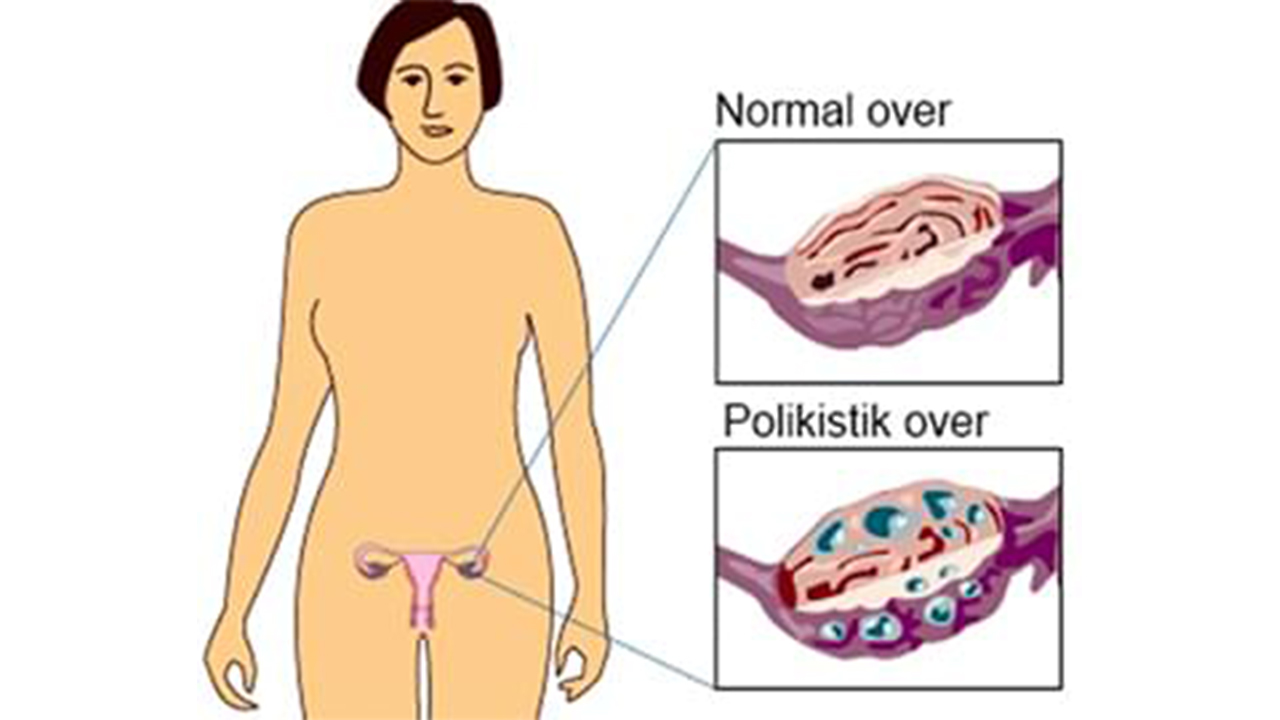 Kadınlarda polikistik over sendromuna dikkat ! 7