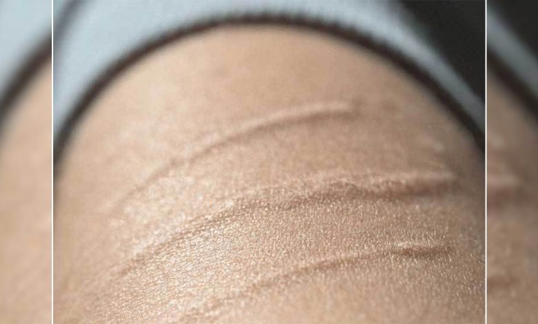 Yara ve ameliyat izleri artık dert değil ! 1