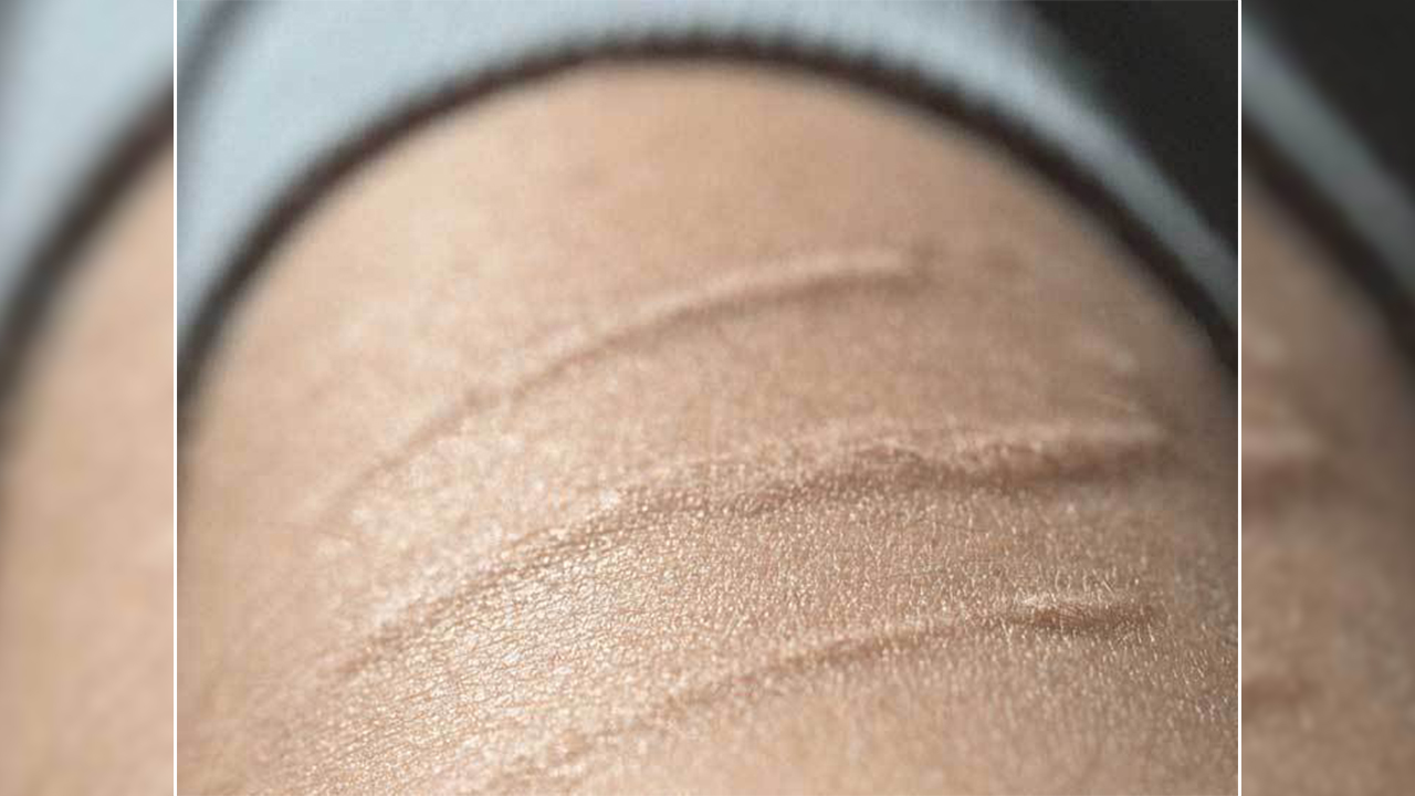 Yara ve ameliyat izleri artık dert değil ! 6