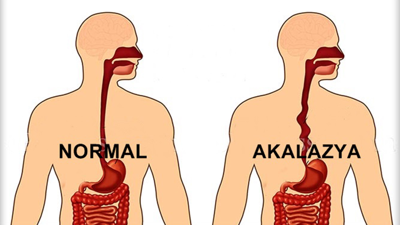 Akalazya hastalığını duydunuz mu? 7