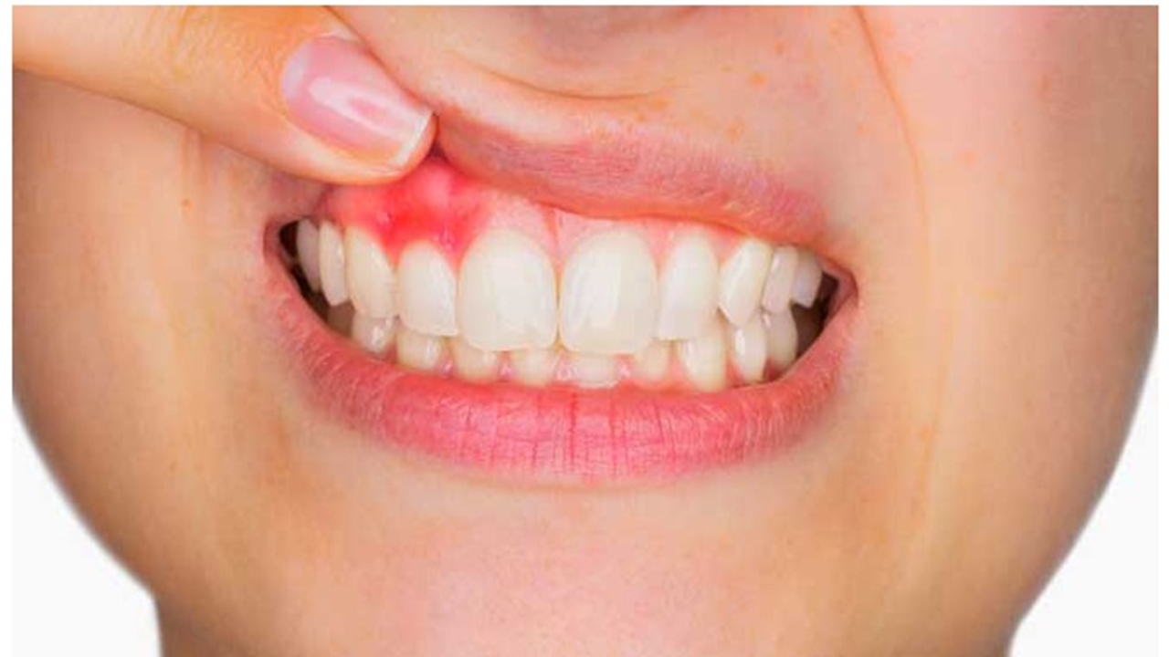 Diş etinde Kırmızılık ve şişkinliğe dikkat ! 7