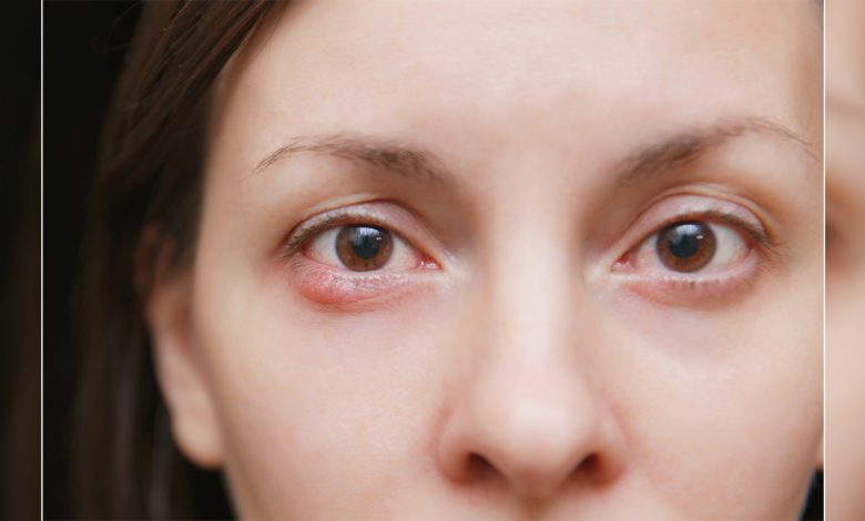 Geçmeyen arpacık göz bozukluğu işareti olabilir! 1