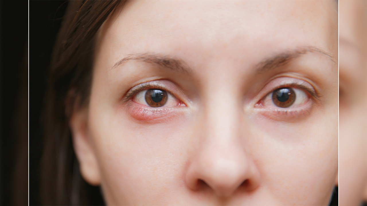 Geçmeyen arpacık göz bozukluğu işareti olabilir! 7