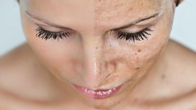 Güneş Lekelerinin Tedavisi mümkün 9