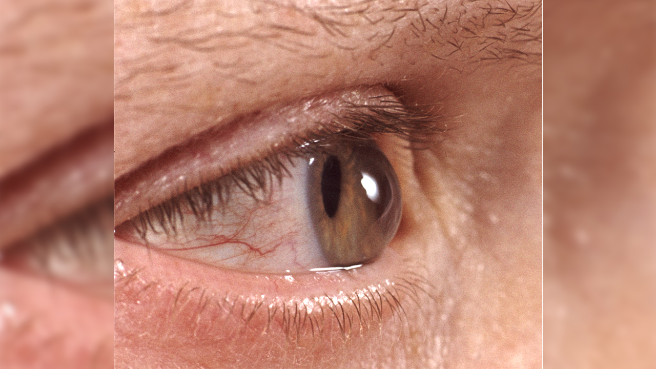 Sonbaharda göz hastalıklarına dikkat! 7