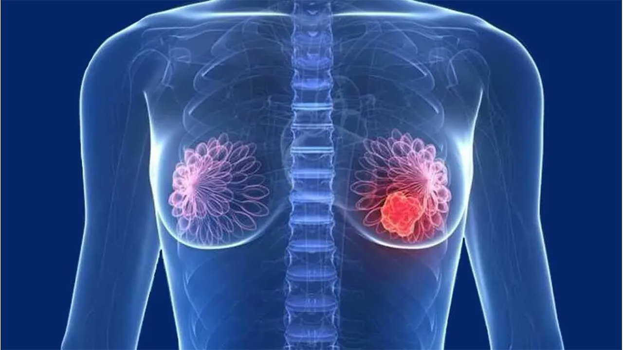 Meme Kanserinin önüne Farkındalık ile Geçebilirsiniz 6