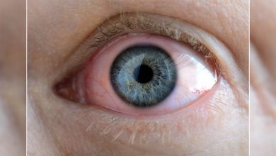 Gözde sulanma ve çapaklanmaya dikkat ! 4