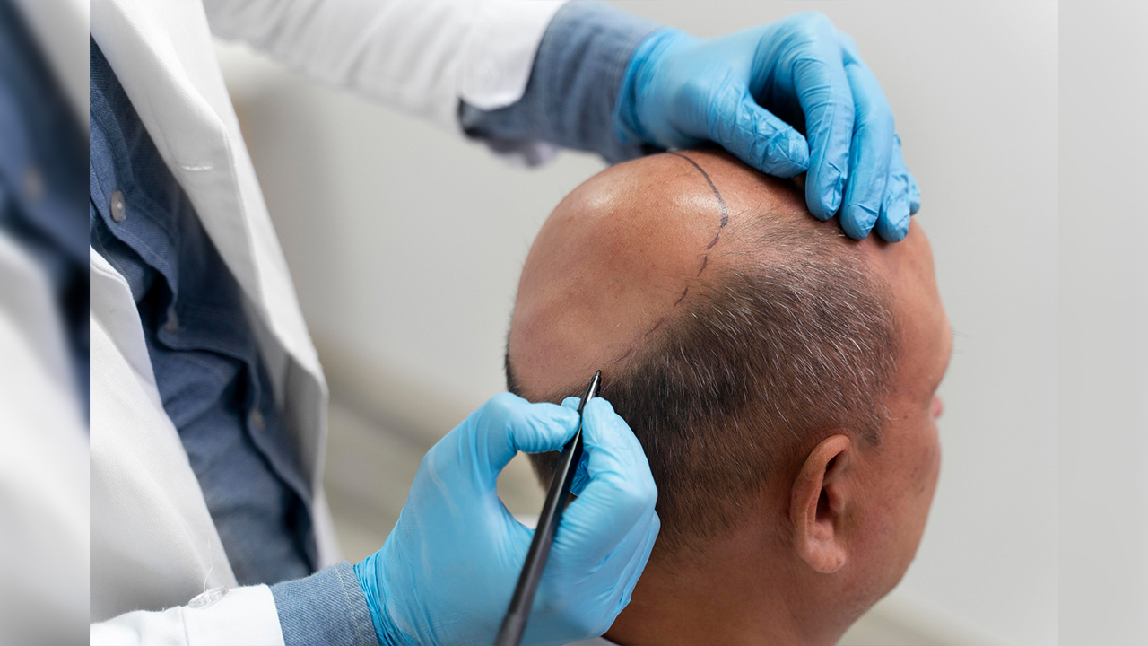 Saç ekimi sağlık için tehdit oluşturur mu? 7
