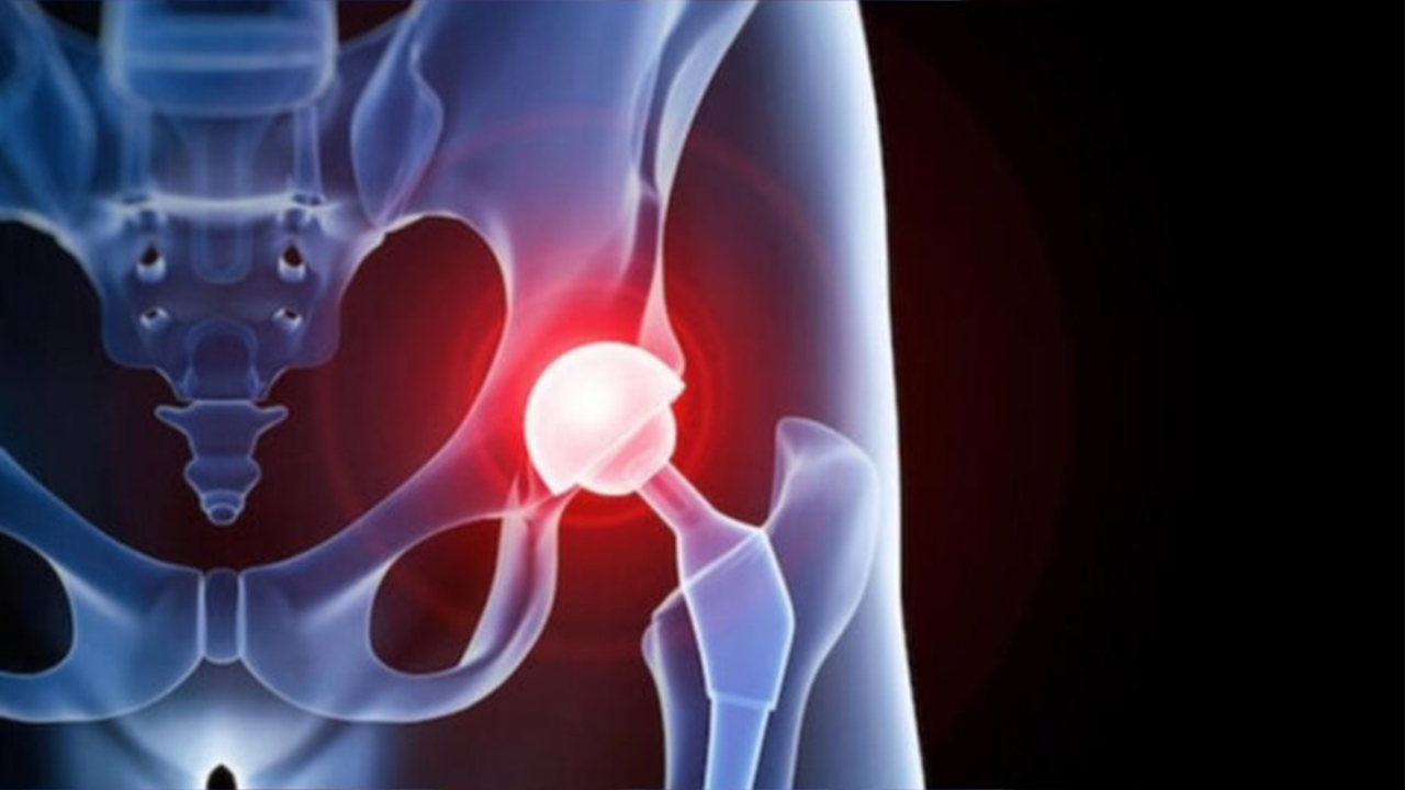 Çocuklarda Kalça Çıkıklığı, Teşhis ve Tedavi 7