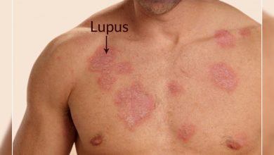 Eklem Ağrılarına Dikkat! Lupus olabilirsiniz 1