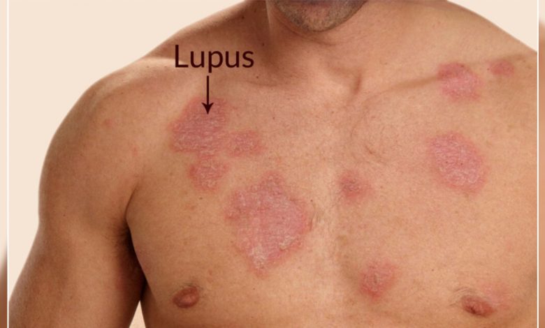 Eklem Ağrılarına Dikkat! Lupus olabilirsiniz 1