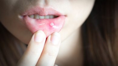 Ağız yaralarını ciddiye alın! 1