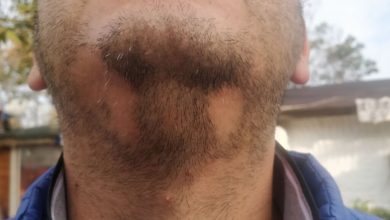 Saçkıran ve Saç dökülmesi sebepleri 1