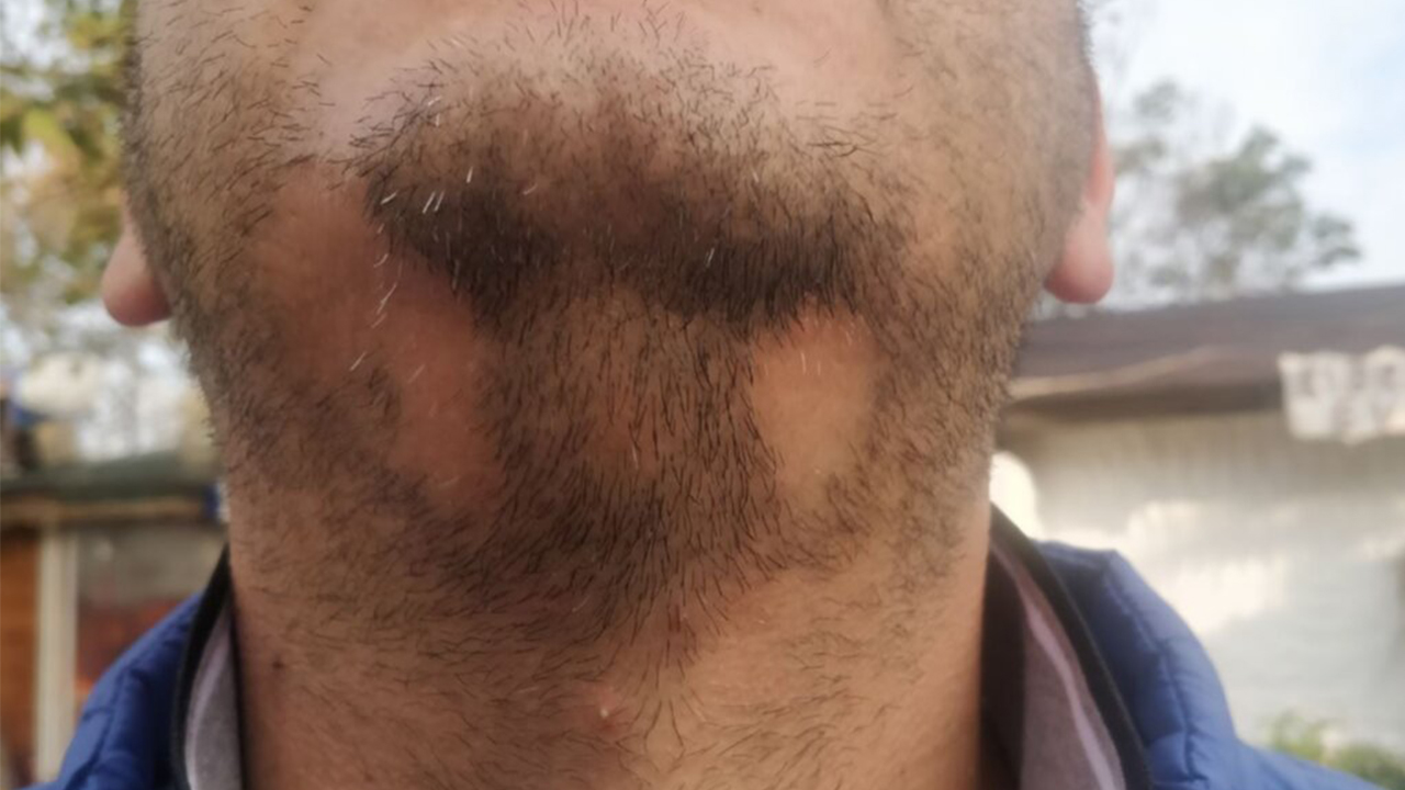 Saçkıran ve Saç dökülmesi sebepleri 7