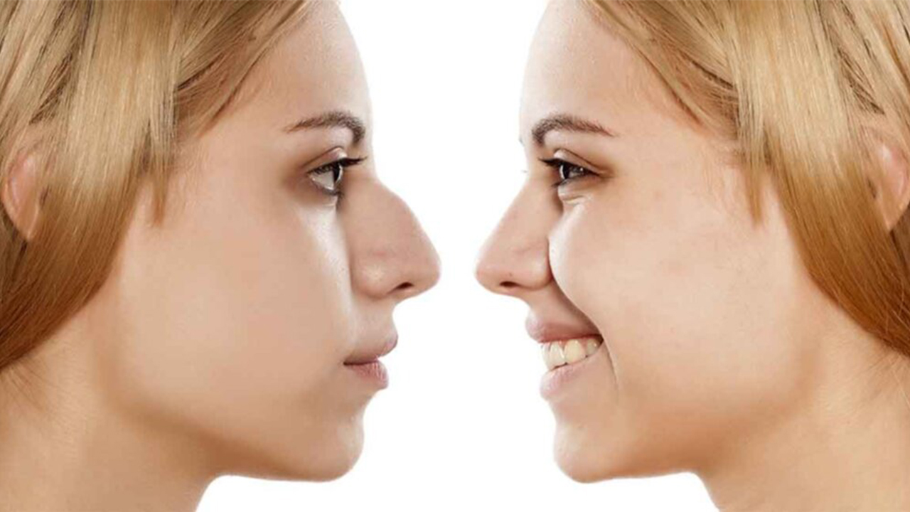 Burun estetiği ile yepyeni bir kişilik kazanın, insanların size bakışını değiştirin 7