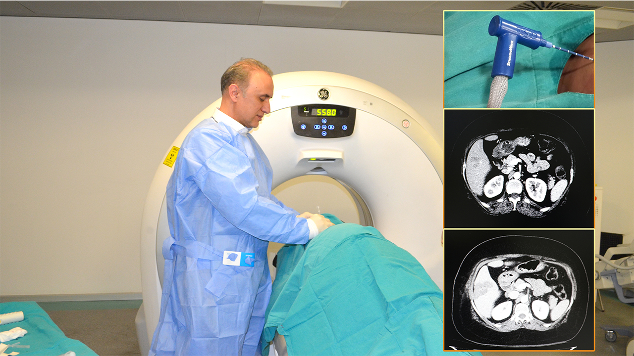 Karaciğer Kanseri Tedavisinde “Mikrodalga Ablasyon” Yöntemi 6