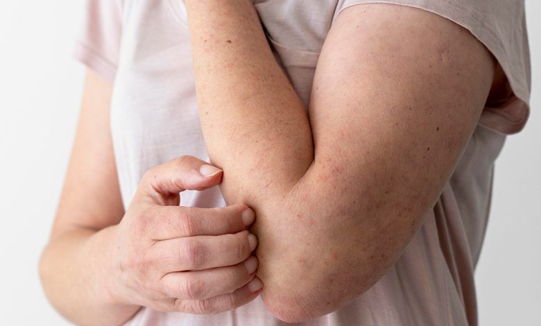 Egzama Tedavisinde yeni yöntem! 1