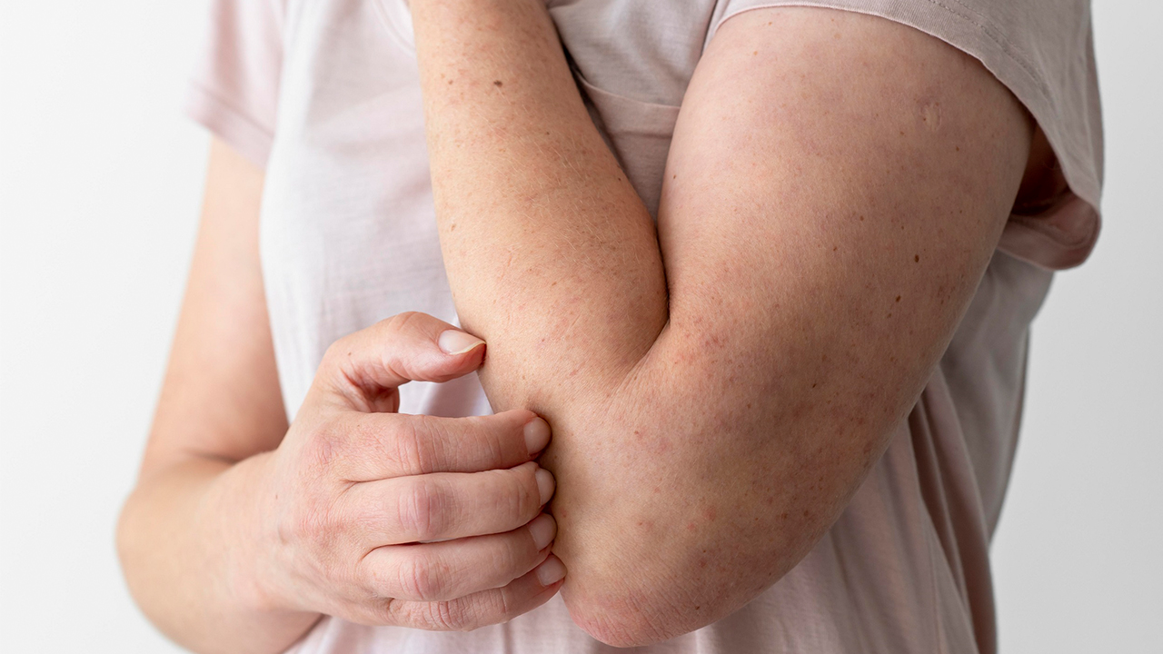 Egzama Tedavisinde yeni yöntem! 6