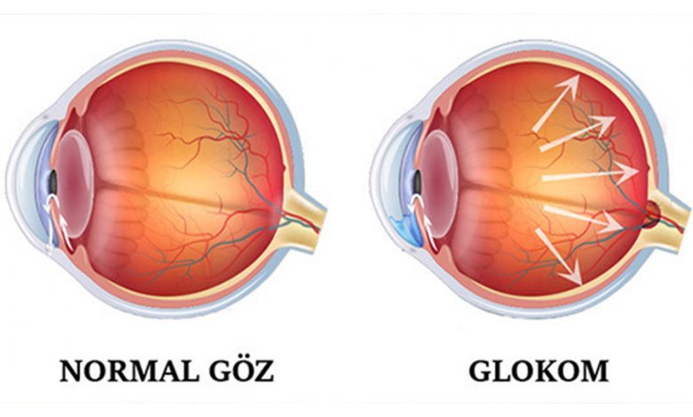 Glokom hakkında merak edilen 8 önemli soru 1