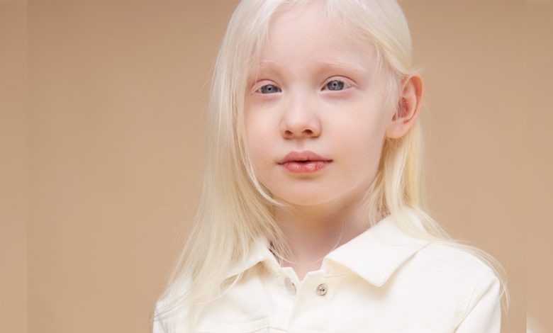 Sık görülen ama ‘nadir’ olduğu bilinmeyen 3 hastalık! 1