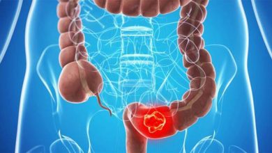 Uzmanlar uyardı! Yanlış beslenme ve hareketsiz yaşam kolon kanserini tetikliyor 5