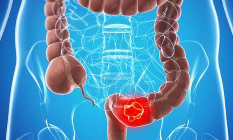 Uzmanlar uyardı! Yanlış beslenme ve hareketsiz yaşam kolon kanserini tetikliyor 1